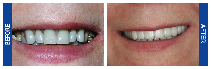 Removable Partial Denture Replaced With Implants And Crowns