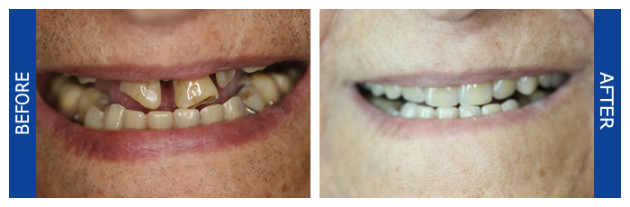 Single Crown And Removable Denture