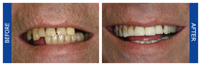 Crowns And A Removable Partial Denture