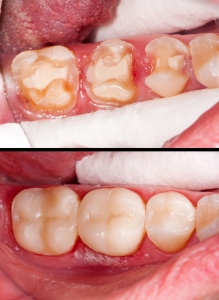 composite fillings