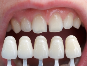 porcelain veneers