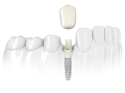 dental implants